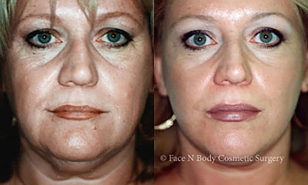 Facelift Before & After