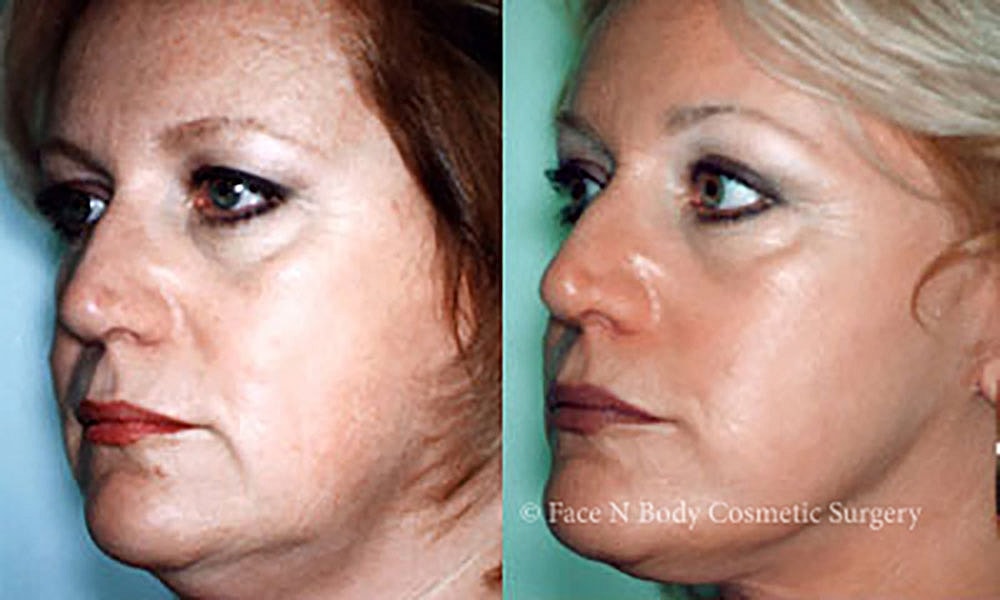 Facelift Before & After