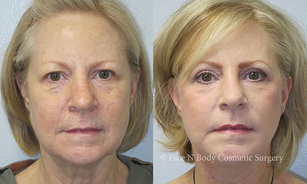 Facelift Before & After