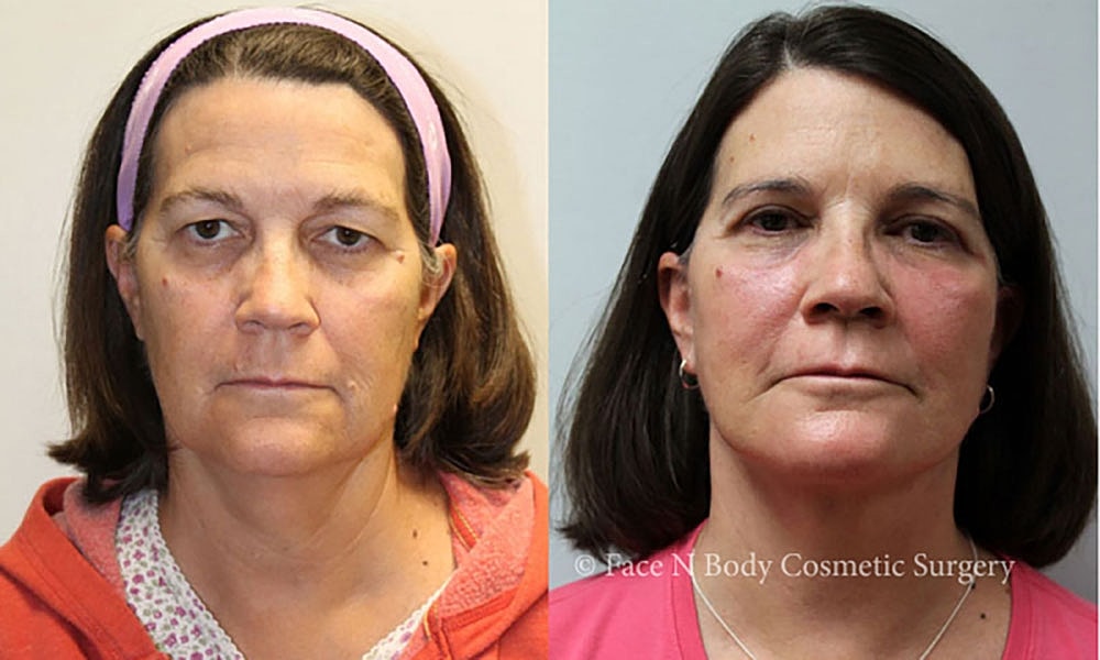 Facelift Before & After