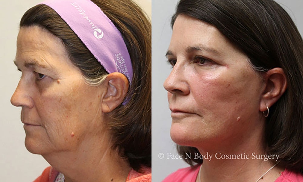 Facelift Before & After