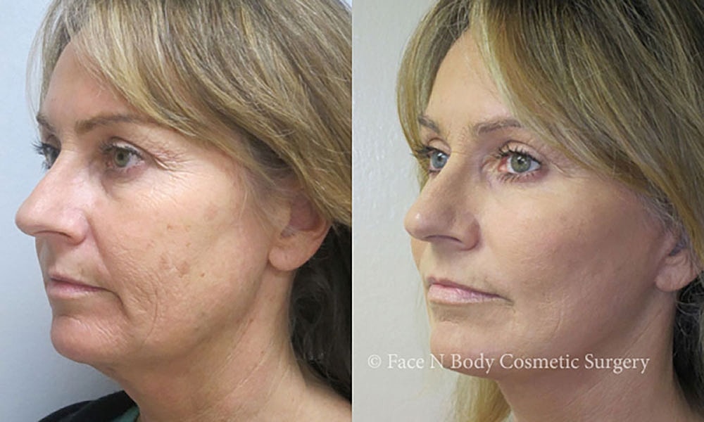 Facelift Before & After