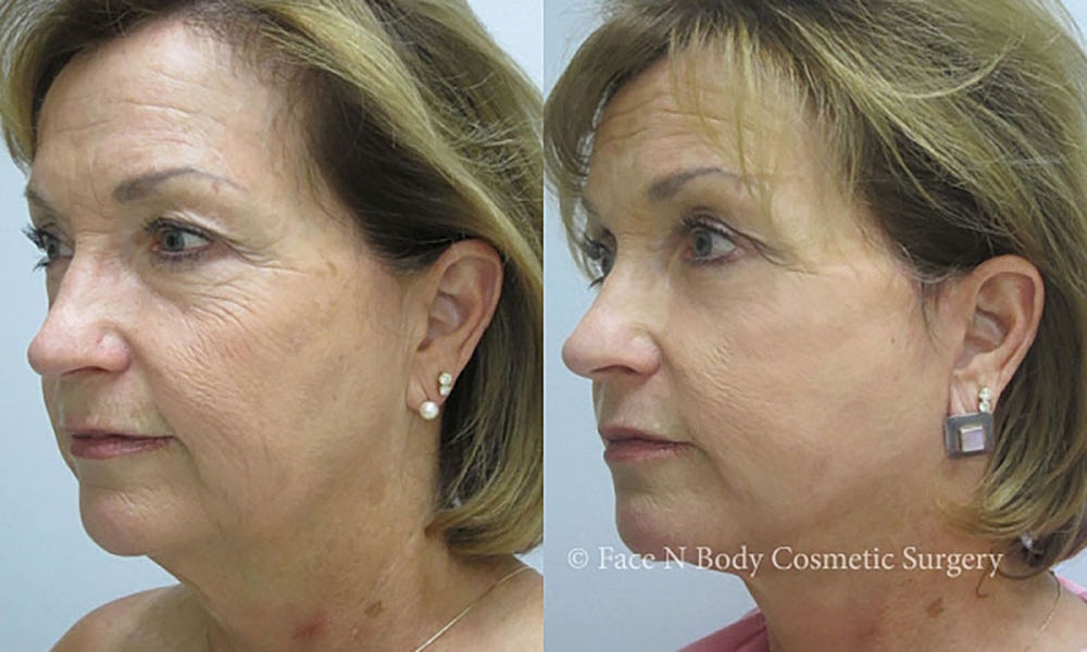 Facelift Before & After