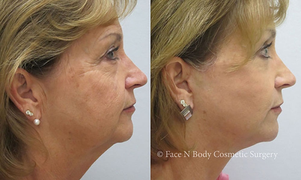 Facelift Before & After