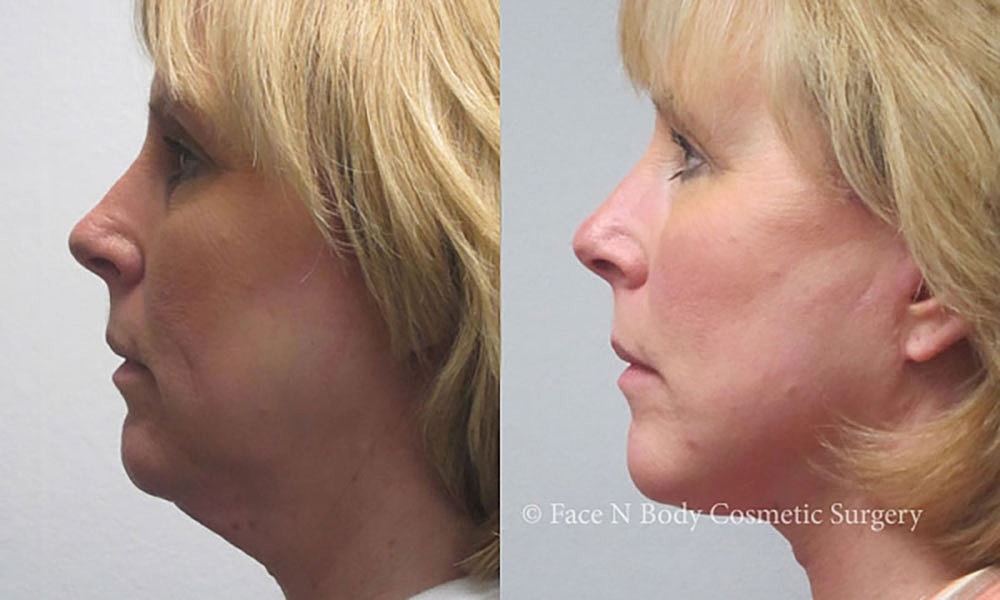 Facelift Before & After