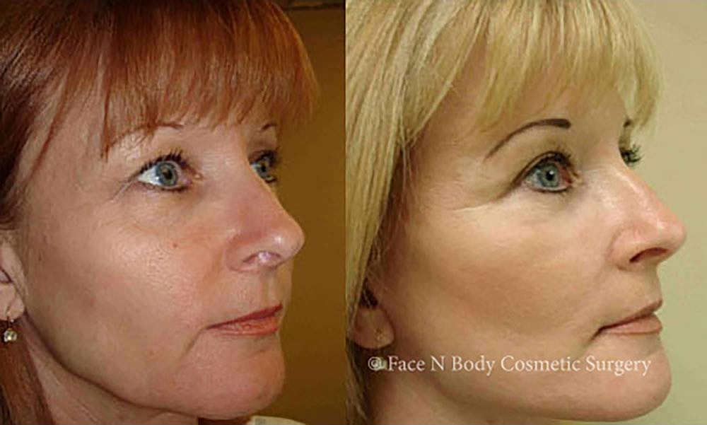 Facelift Before & After
