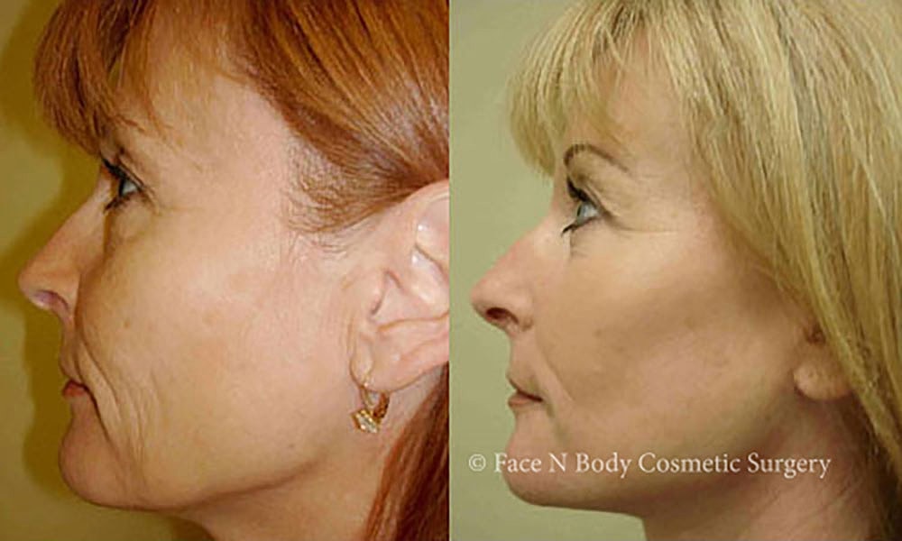 Facelift Before & After