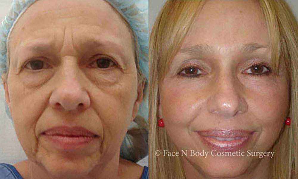 Facelift Before & After