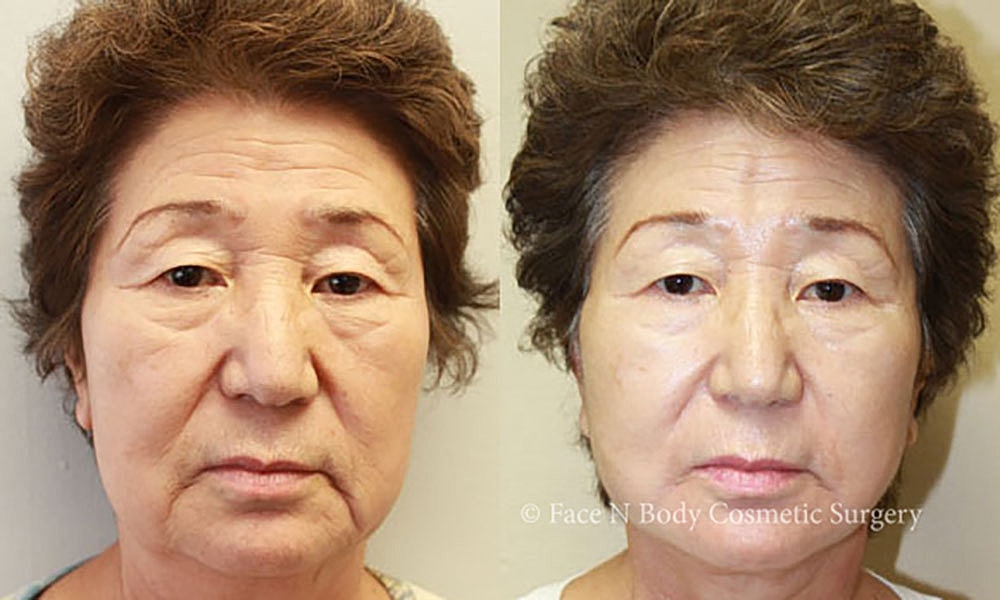 Facelift Before & After