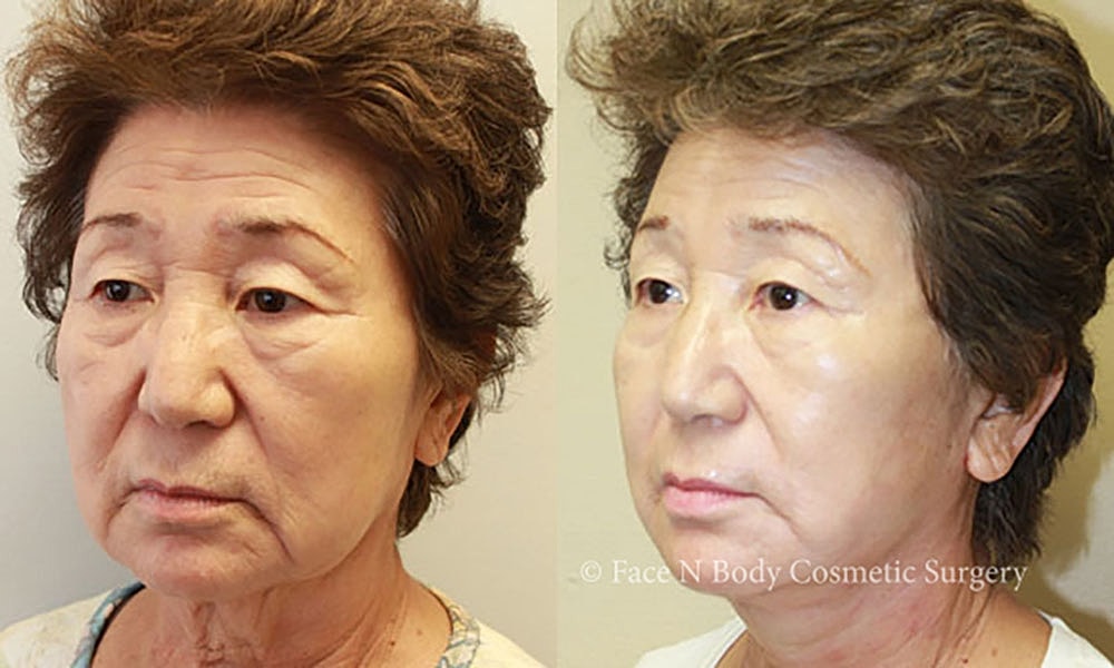 Facelift Before & After