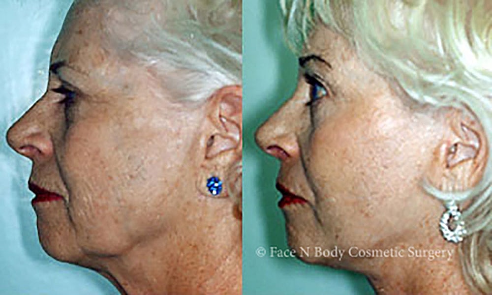 Facelift Before & After