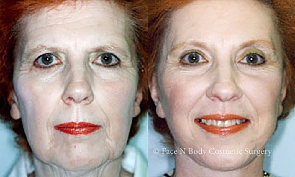 Facelift Before & After