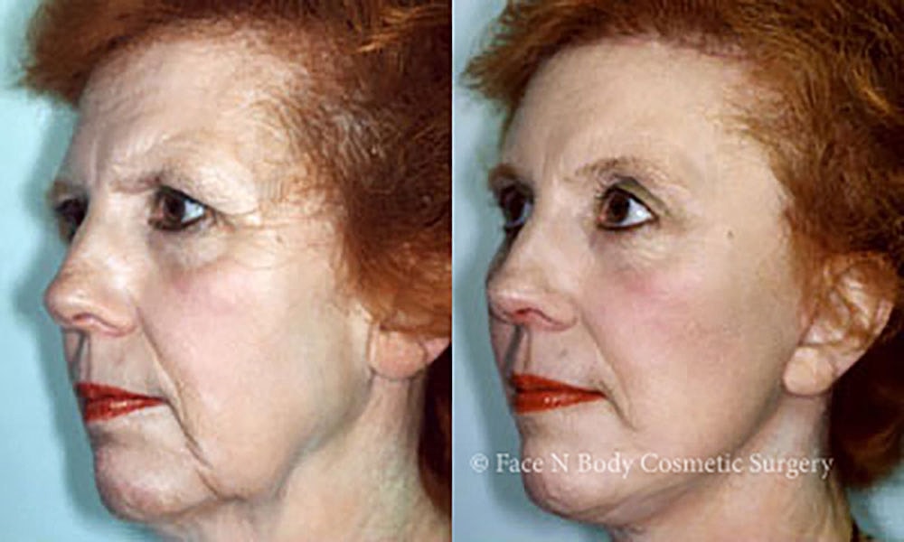 Facelift Before & After