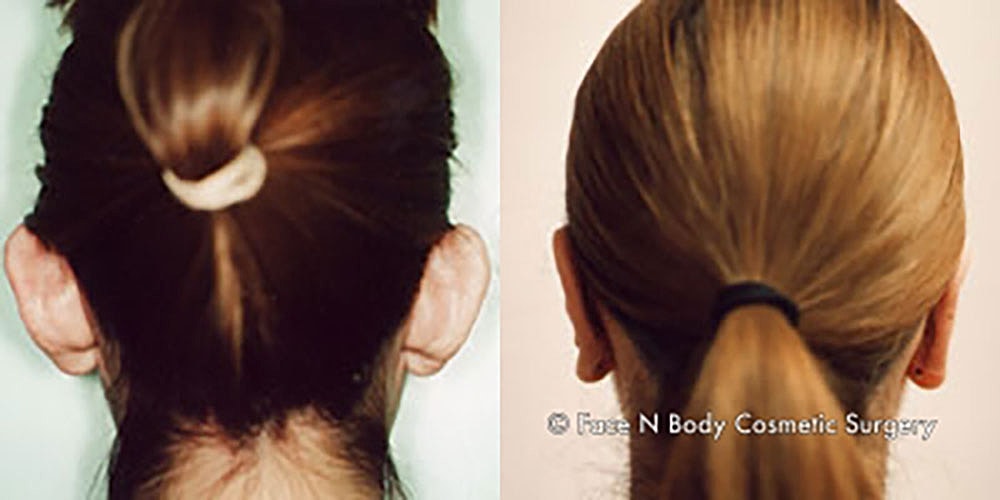 Ear Pinning Before & After