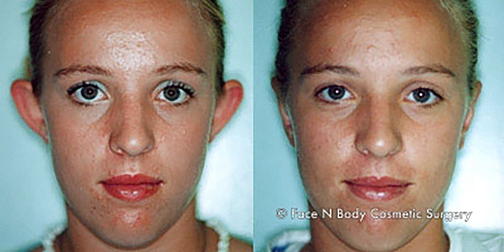Ear Pinning Before & After