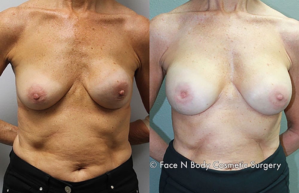 Breast Revision Before & After
