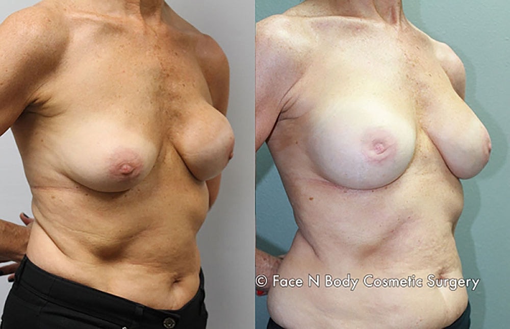 Breast Revision Before & After