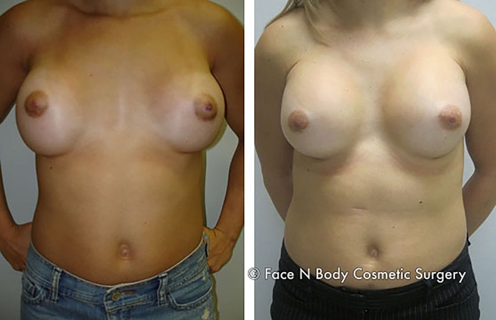 Breast Revision Before & After