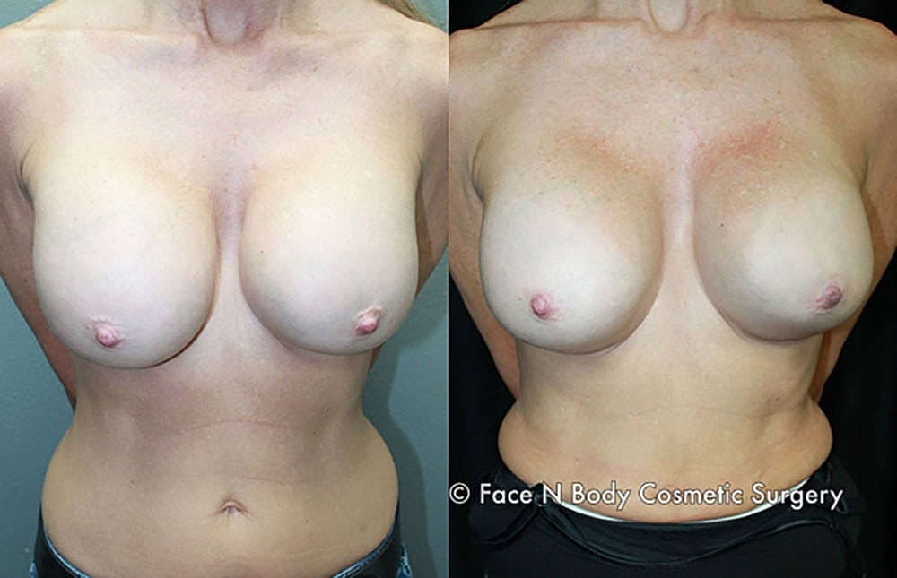 Breast Revision Before & After
