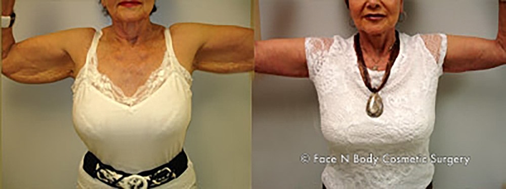 Brachioplasty Before & After