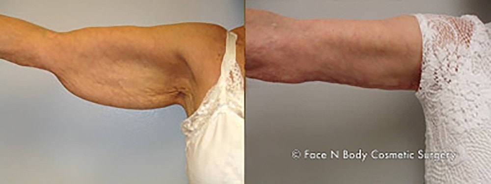 Brachioplasty Before & After