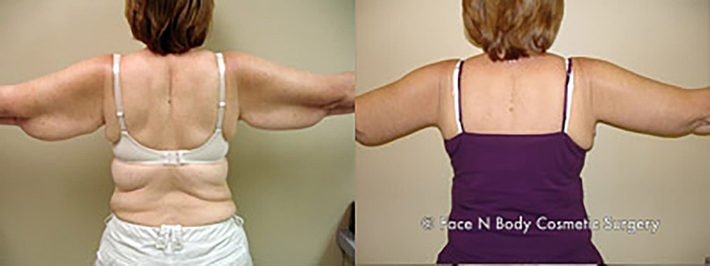 Brachioplasty Before & After