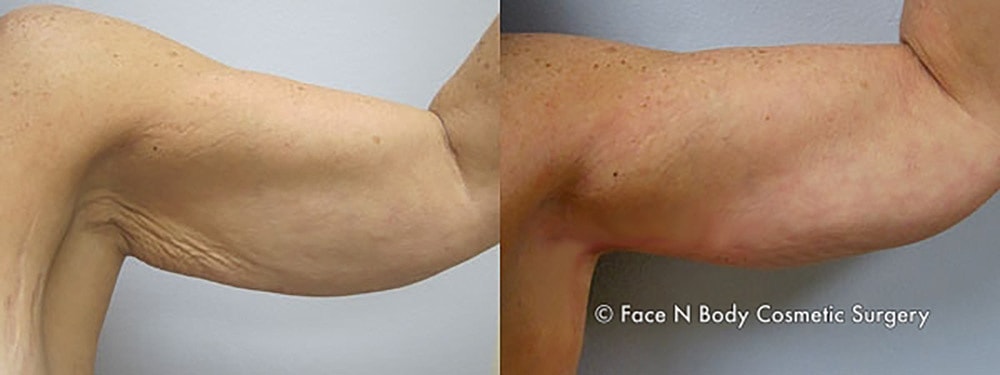 Brachioplasty Before & After