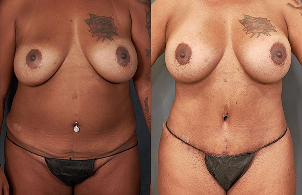 Mommy Makeover Before & After