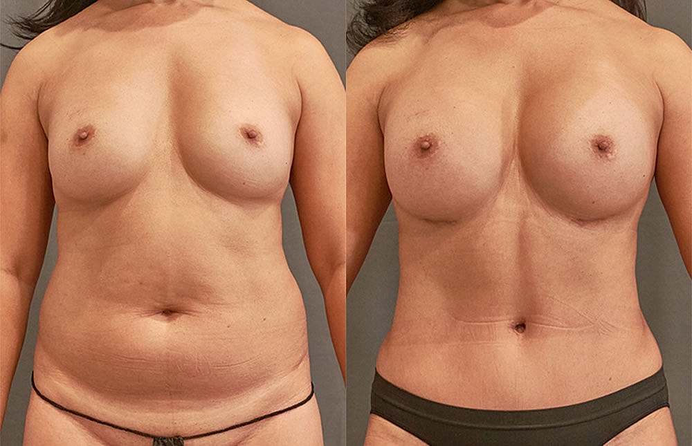 Mommy Makeover Before & After