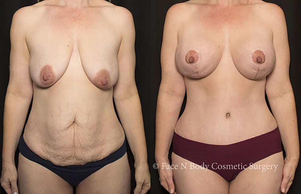 Mommy Makeover Before & After