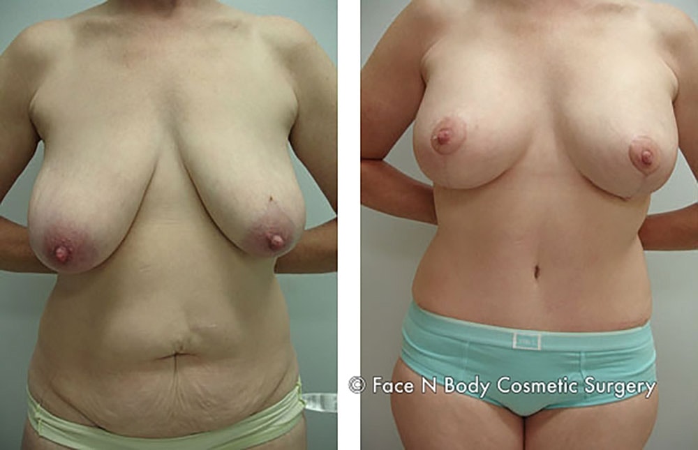 Mommy Makeover Before & After