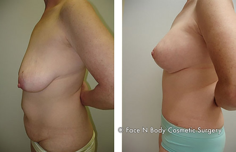 Mommy Makeover Before & After