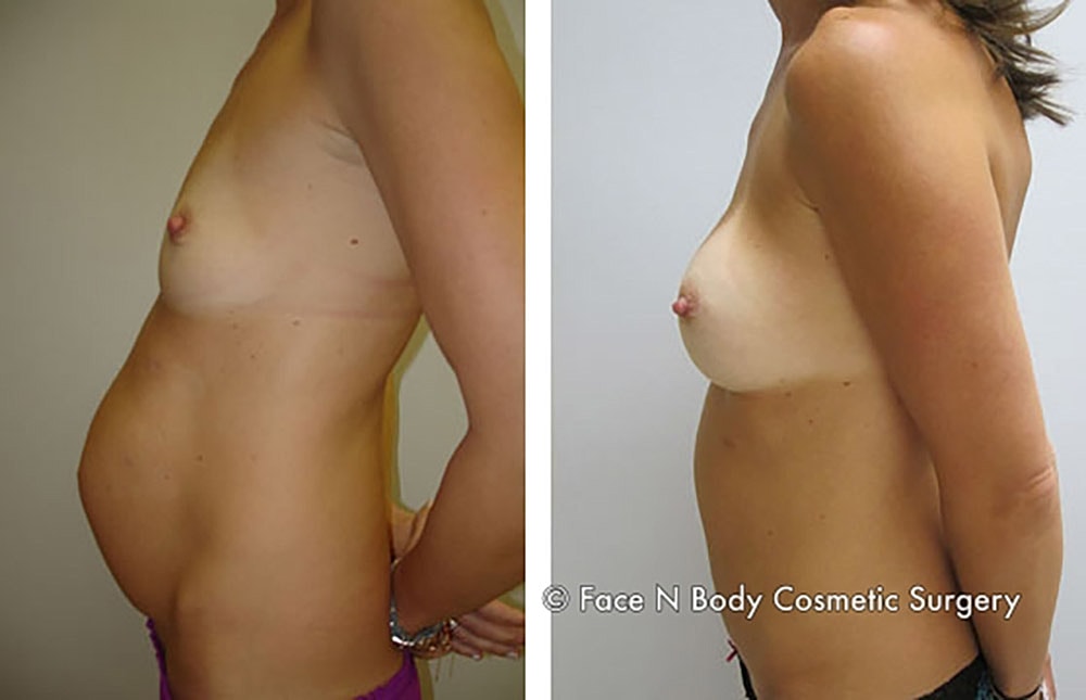 Mommy Makeover Before & After