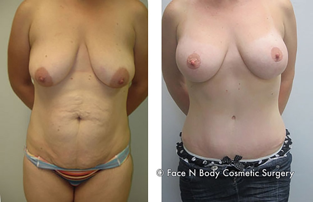 Mommy Makeover Before & After