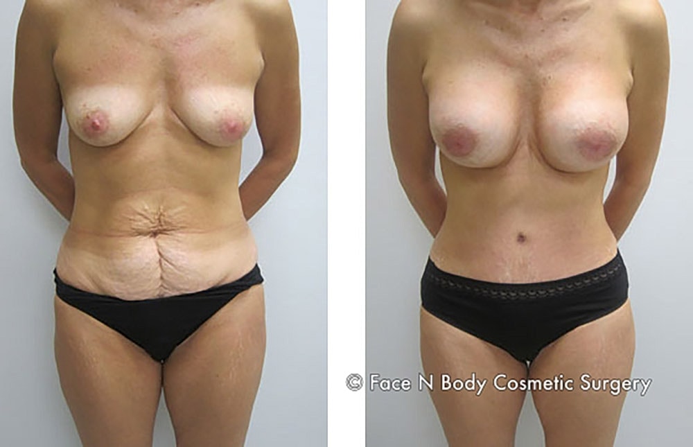 Mommy Makeover Before & After