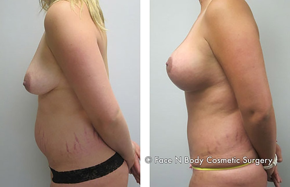 Mommy Makeover Before & After