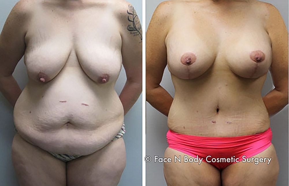 Mommy Makeover Before & After