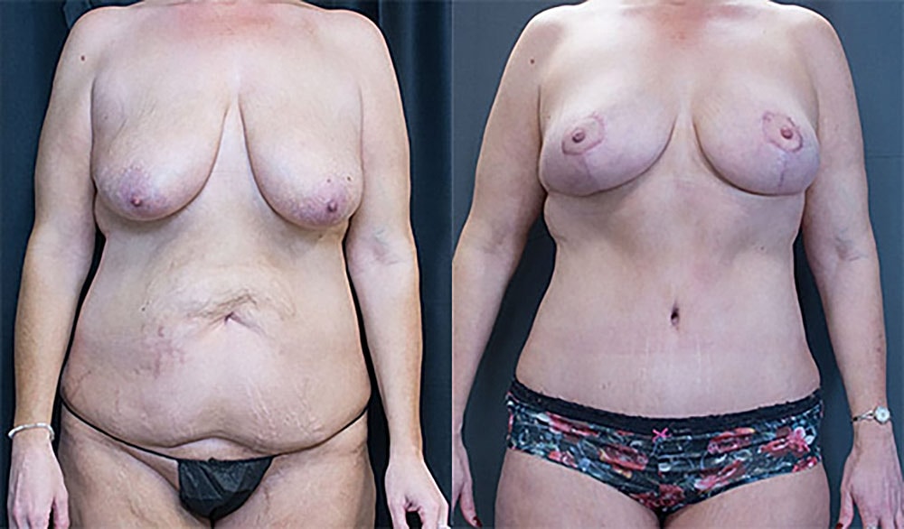 Mommy Makeover Before & After