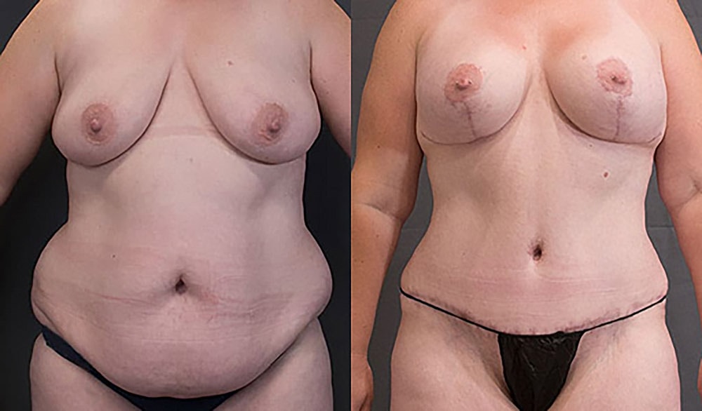 Mommy Makeover Before & After