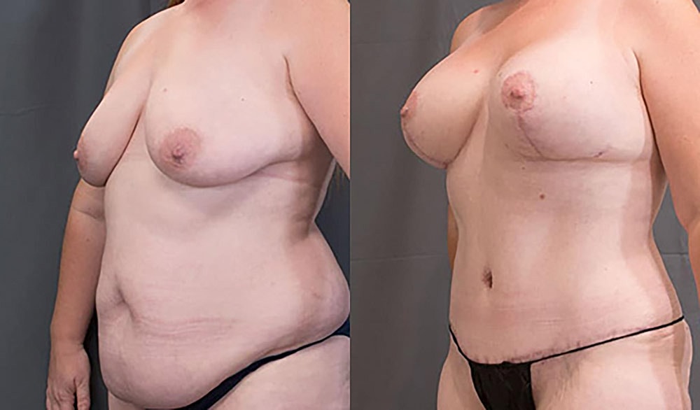 Mommy Makeover Before & After