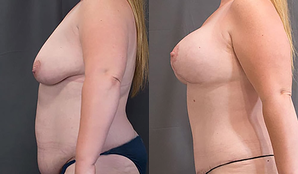 Mommy Makeover Before & After