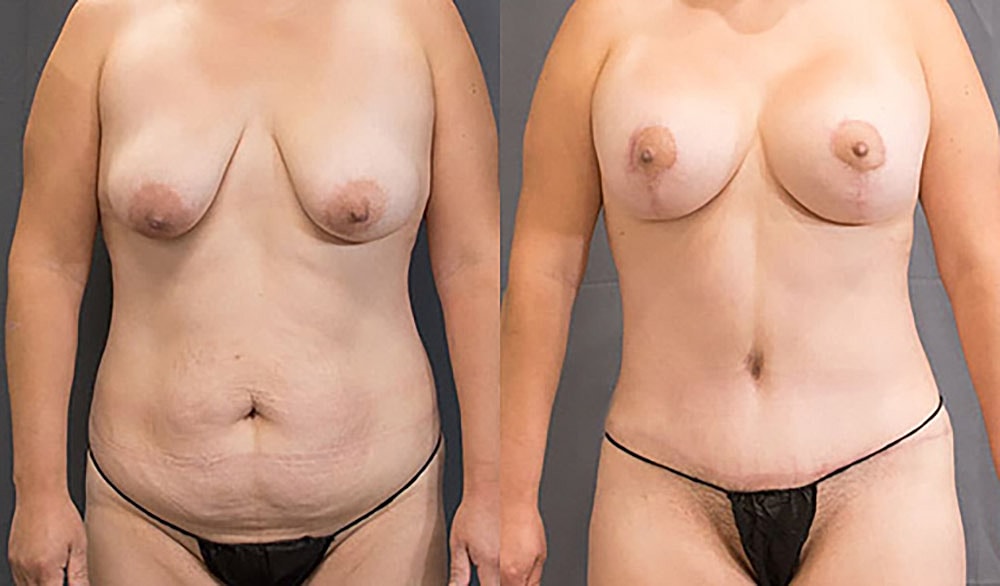 Mommy Makeover Before & After