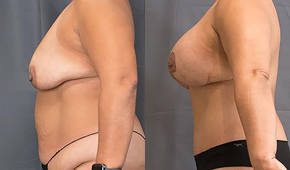 Mommy Makeover Before & After