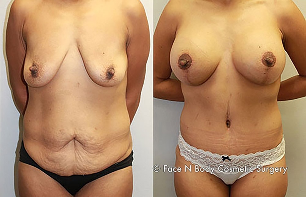 Mommy Makeover Before & After