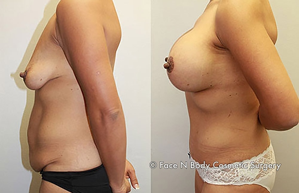 Mommy Makeover Before & After