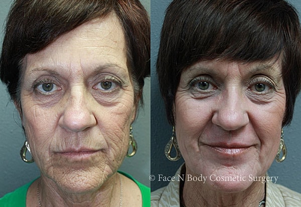 Laser Skin Resurfacing Before & After