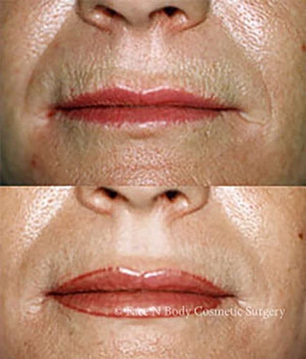 Laser Skin Resurfacing Before & After