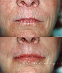 Laser Skin Resurfacing Before & After