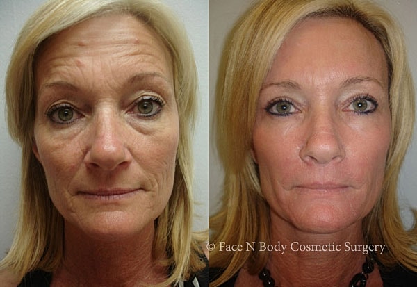 Laser Skin Resurfacing Before & After