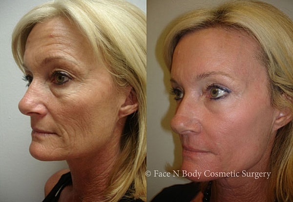 Laser Skin Resurfacing Before & After